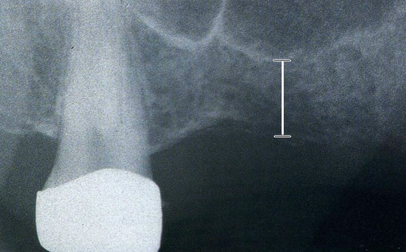 Radiografia endorale che mette in evidenza uno spessore osseo  non sufficiente per poter posizionare un impianto di almeno 8-10 mm.