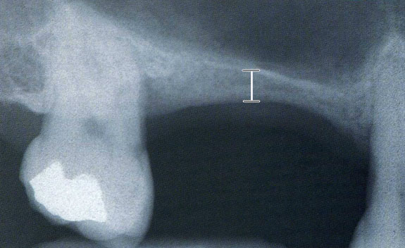 Rx- endorale che mette in evidenza in corrispondenza della zona posteriore del mascellare una quantità ridottissima di  osso in senso verticale.
