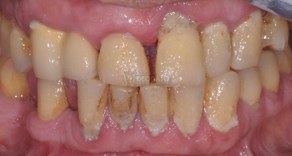 Notevole accumulo di placca batterica in un paziente affetto da malattia parodontale conclamata.