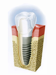 Implantologia dentale