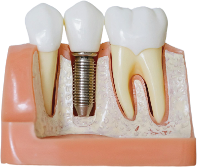 Implantoprotesi computer guidata