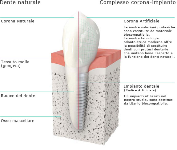 Dente naturale e impianto dentale