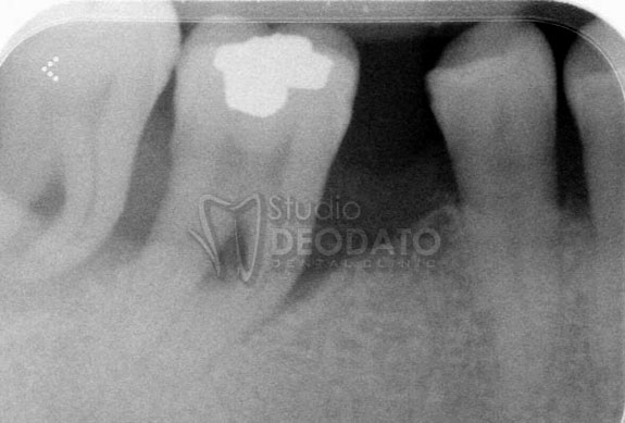 Piorrea avanzata con tasca ossea profonda