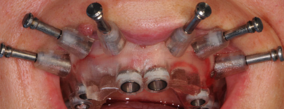 Casi clinici di implanto-protesi computer assistita